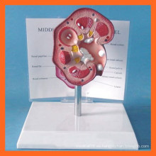 Medical Kidney Model Modelo Anatómico de Piedras Renales